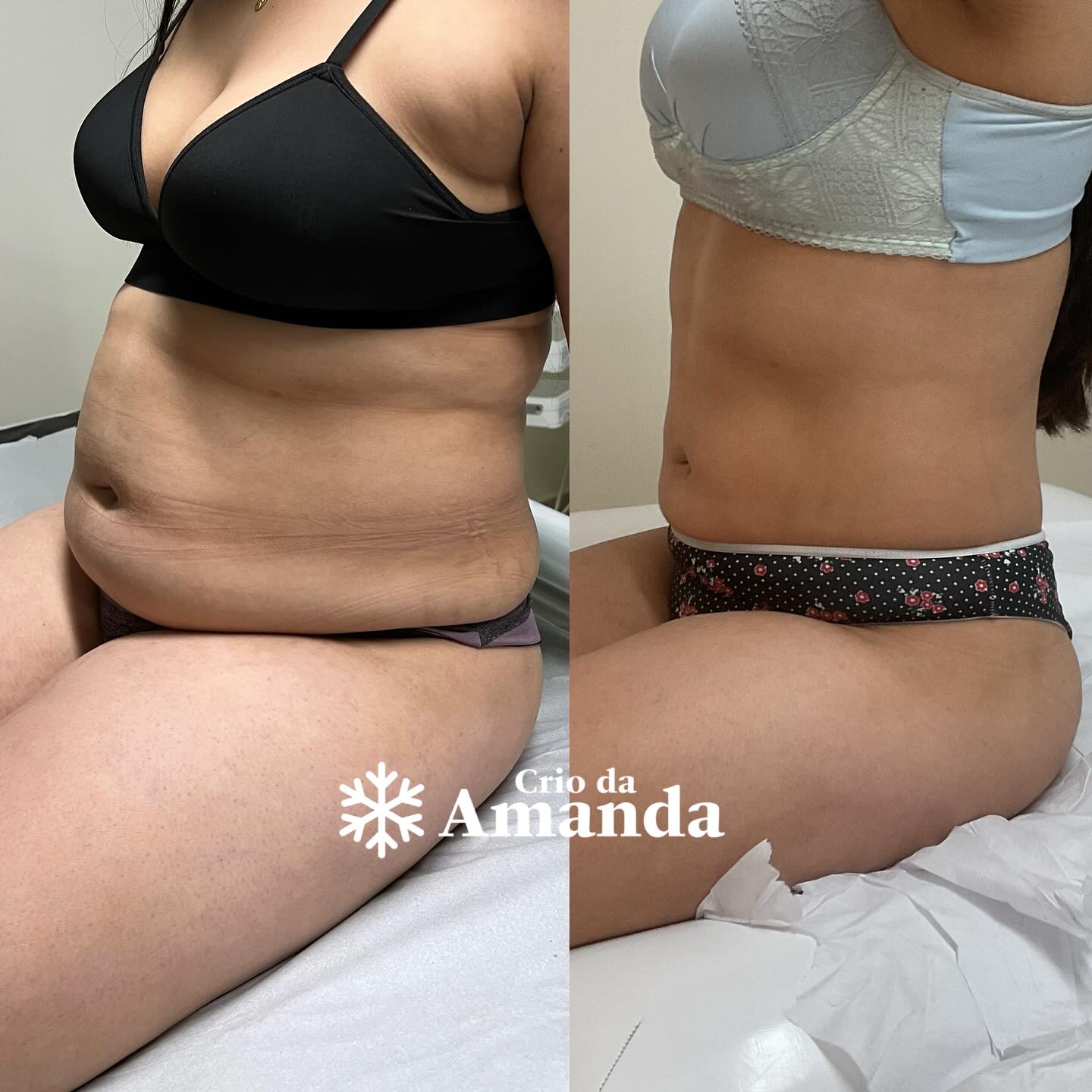 CrioHarmonização - Tratamento corporal na Clínica Amanda Sobottka